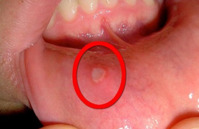Remédios caseiros para acabar com as incômodas aftas