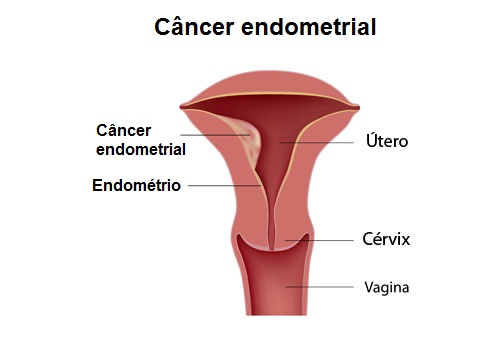 Imagem do câncer endometrial