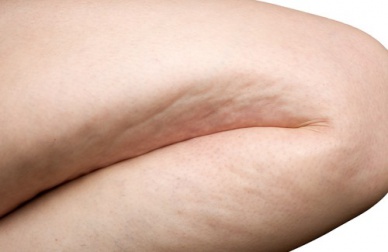 Bebida e conselhos para reduzir a celulite