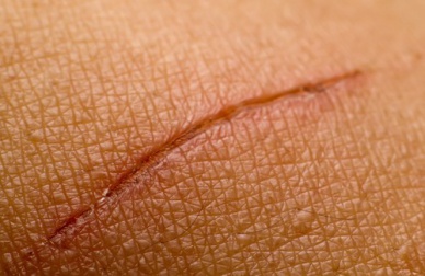 Como atenuar as cicatrizes naturalmente?