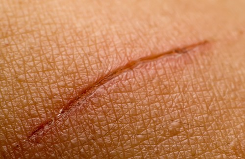 Como atenuar as cicatrizes naturalmente?