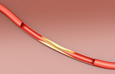 Medidas que devem ser tomadas para controlar o colesterol alto