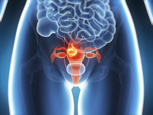 Endometriose