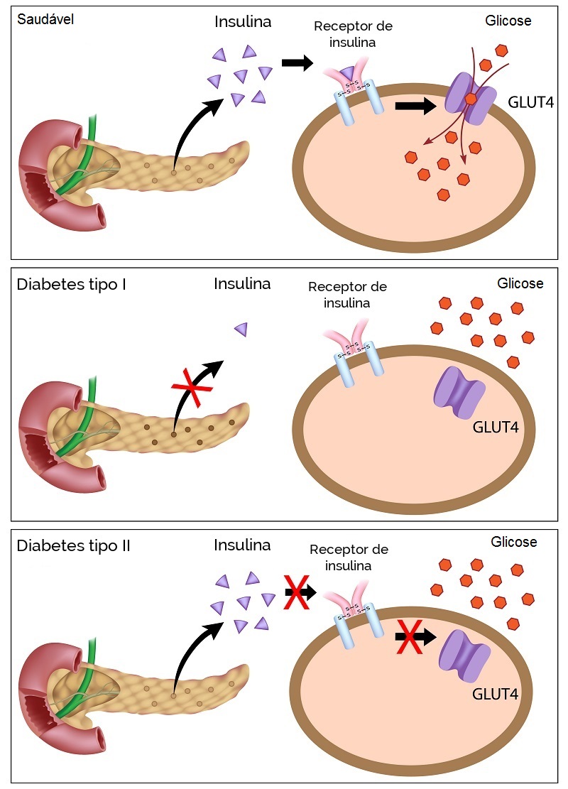 Glicose-diabetes