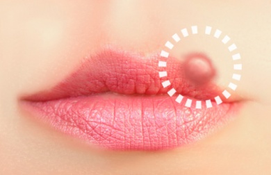 Soluções naturais para o herpes labial