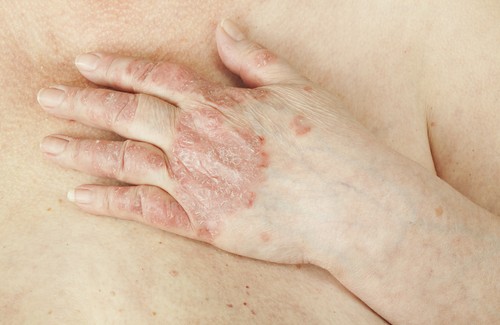 Tratamento natural da psoríase