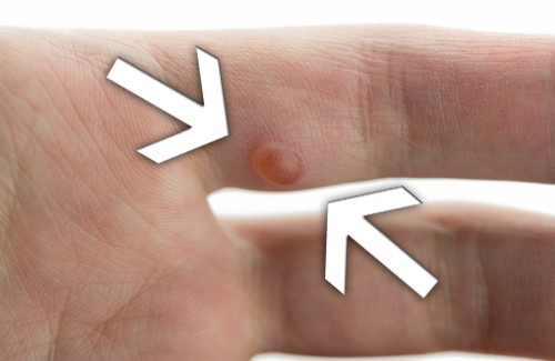 Como remover verrugas naturalmente?