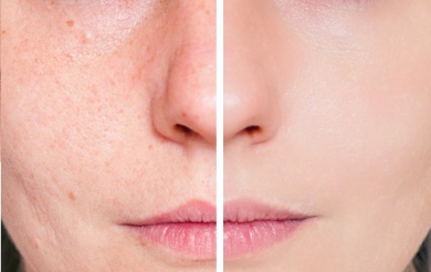 Remédios naturais para cicatrizes de acne