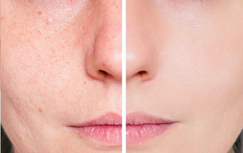 Remédios naturais para cicatrizes de acne