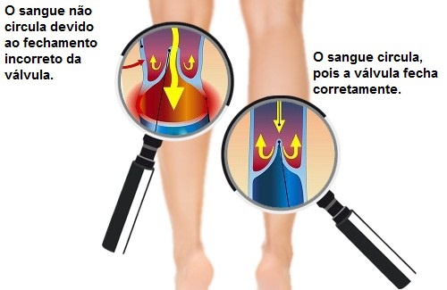 Como melhorar a circulação nos braços e nas pernas?