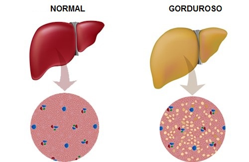 Dicas para combater o fígado gorduroso