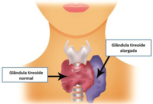 O hipertiroidismo é uma das principais doenças da tireoide