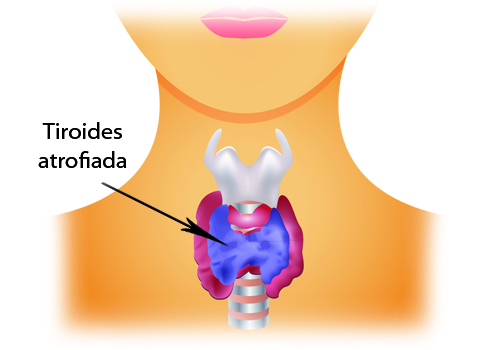 Principais doenças da tireoide