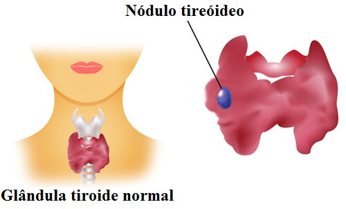 O nódulo tireoidiano é uma das principais doenças da tireoide 