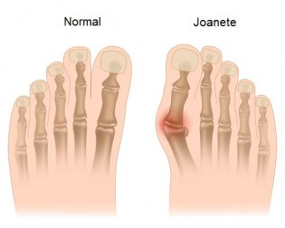 Como prevenir os joanetes? Saiba mais