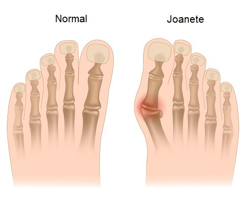 Diga adeus ao joanete