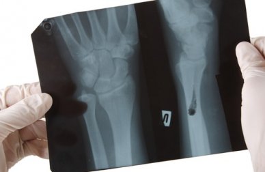 Fortaleça seus ossos com cálcio de origem vegetal