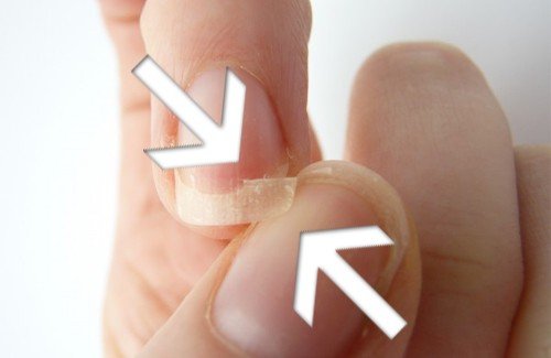 Causas e tratamentos para unhas frágeis