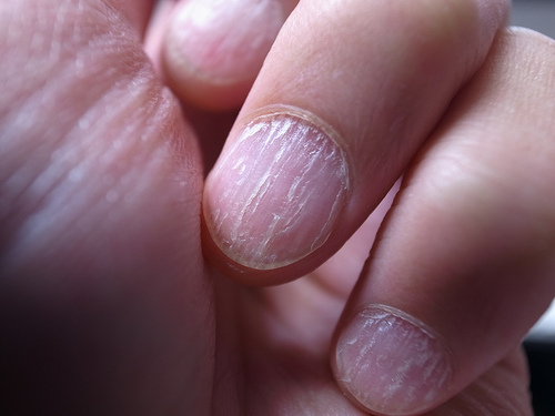 para micose nas unhas