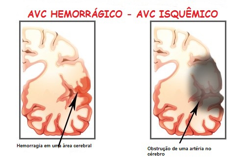 Sintomas de um acidente vascular cerebral (AVC)