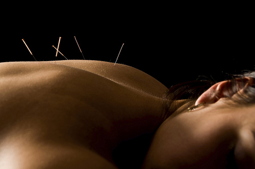 Podemos aliviar a tireoidite com acupuntura