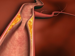 Arteriosclerosis