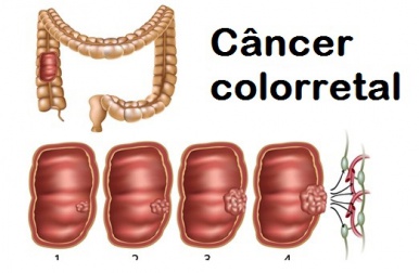 Como conhecer e prevenir o câncer colorretal