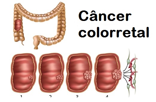 Como conhecer e prevenir o câncer colorretal Como conhecer e prevenir o câncer colorretal