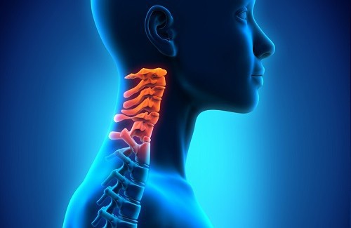 Ilustração de pessoa com espondilose cervical