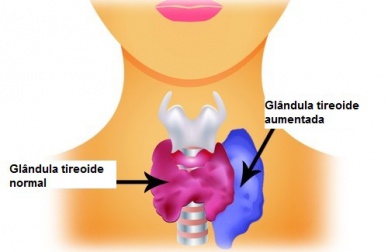 Hipertireoidismo em mulheres, sintomas e alimentos recomendados