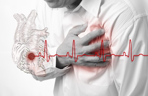 Você sabe reconhecer os sintomas de um infarto? Você sabe reconhecer os sintomas de um infarto?