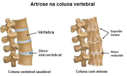 Artrose nas vértebras