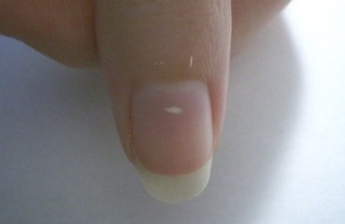 Manchas brancas nas unhas: veja o que elas significam