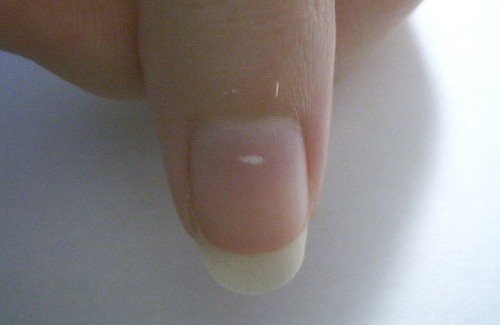 Manchas brancas nas unhas: veja o que elas significam