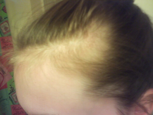 a alopecia