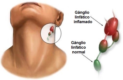 O que causa a inflamação dos gânglios linfáticos? O que causa a inflamação dos gânglios linfáticos?