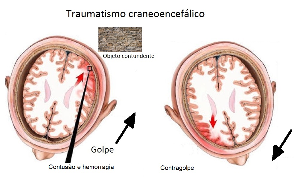 Traumatismos no cérebro
