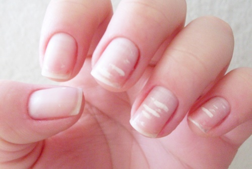manchas brancas nas unhas