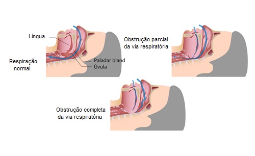 A posição favorece o ronco
