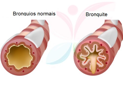 O tratamento de bronquite pode incluir o consumo de alho em jejum