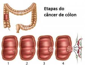 cancerul de colon se ia