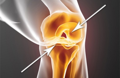 Como reconstituir rapidamente as cartilagens desgastadas?