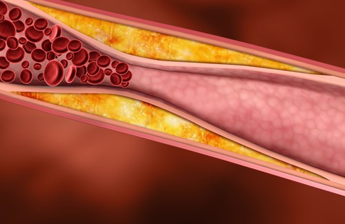 Colesterol nas artérias
