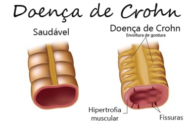 Doença de Crohn: sintomas e tratamento