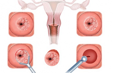 Sintomas e tratamento para a erosão cervical