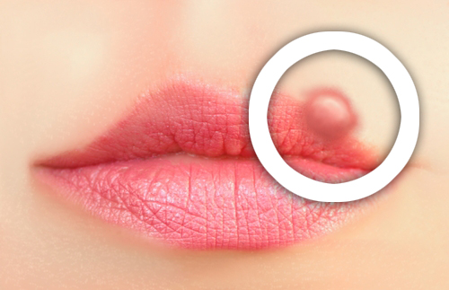 Como prevenir o herpes labial?
