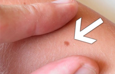 Como identificar as pintas perigosas?