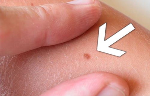 Como identificar as pintas perigosas?
