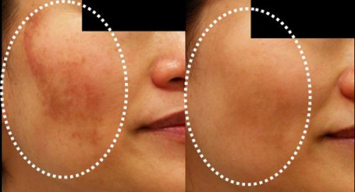 Como tratar o melasma naturalmente
