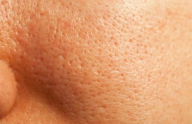 Tratamento natural dos poros dilatados